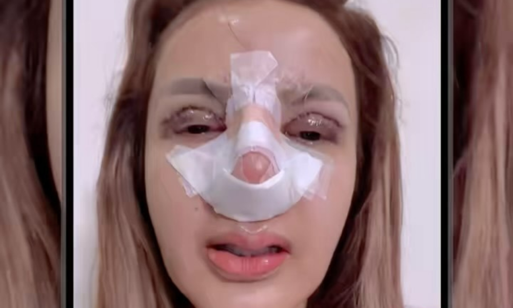 Barbie Kumalasari Operasi Plastik hingga 9 Kali, Datang ke Tv dengan Wajah Penuh Perban