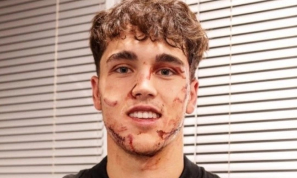 Bek Barcelona Spartan Pau Cubarsi Sobek 10 Jahitan, Tetap Beri Senyum ke Netizen