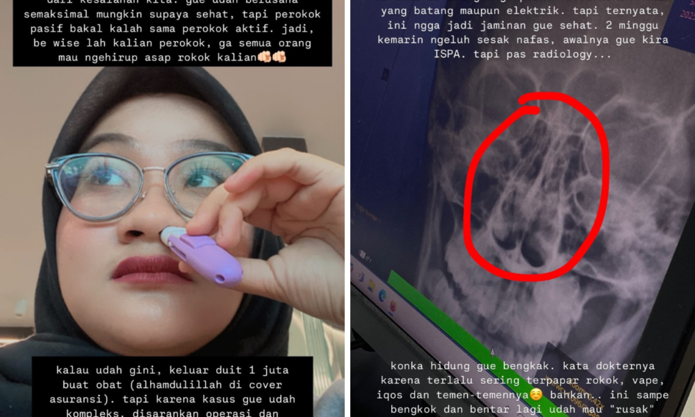 Wanita Ini Alami Hipertrofi Konka hingga Sinusitis Gegara jadi Perokok Pasif