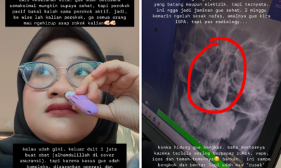 Wanita Ini Alami Hipertrofi Konka hingga Sinusitis Gegara jadi Perokok Pasif