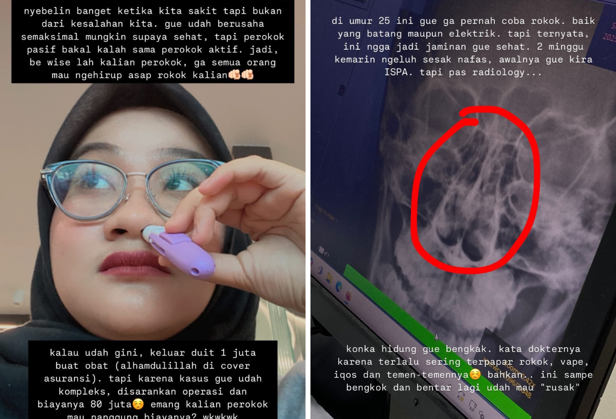 Wanita Ini Alami Hipertrofi Konka hingga Sinusitis Gegara jadi Perokok Pasif