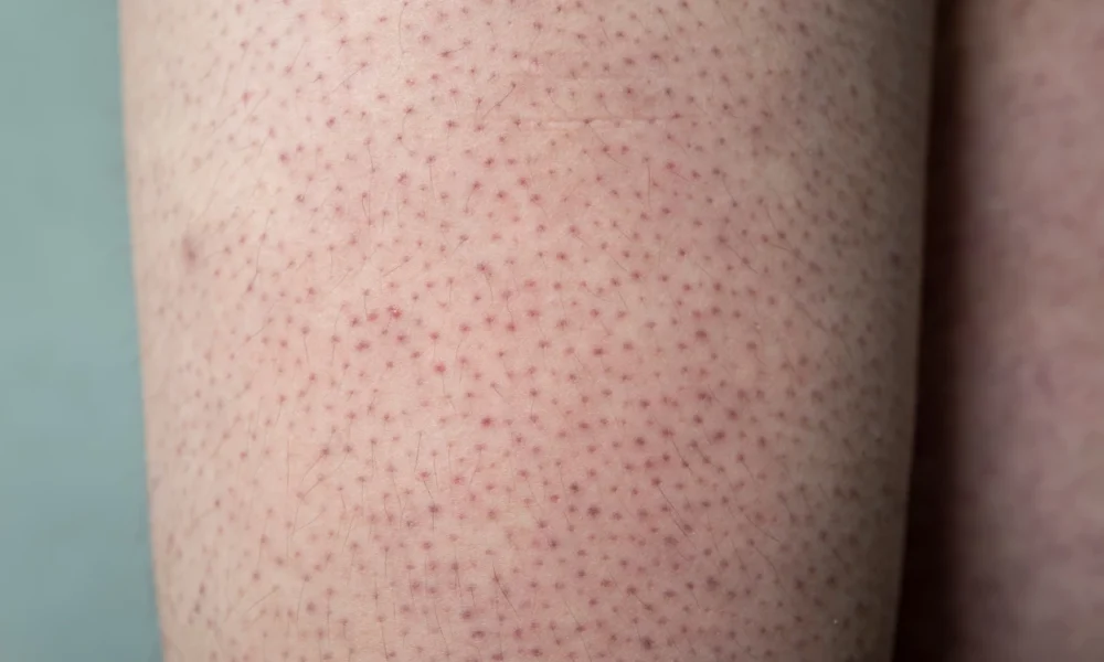 Apa itu keratosis pilaris simak penyebab, gejala, dan cara mengatasinya dengan perawatan yang tepat