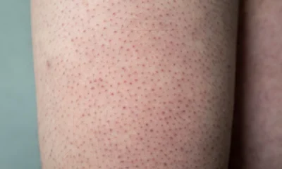 Apa itu keratosis pilaris simak penyebab, gejala, dan cara mengatasinya dengan perawatan yang tepat