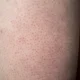 Apa itu keratosis pilaris simak penyebab, gejala, dan cara mengatasinya dengan perawatan yang tepat