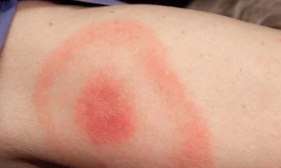 Apa itu lyme disease ternyata ini penyebabnya