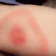 Apa itu lyme disease ternyata ini penyebabnya