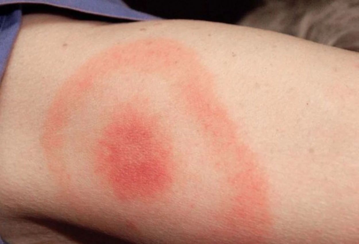 Apa itu lyme disease ternyata ini penyebabnya