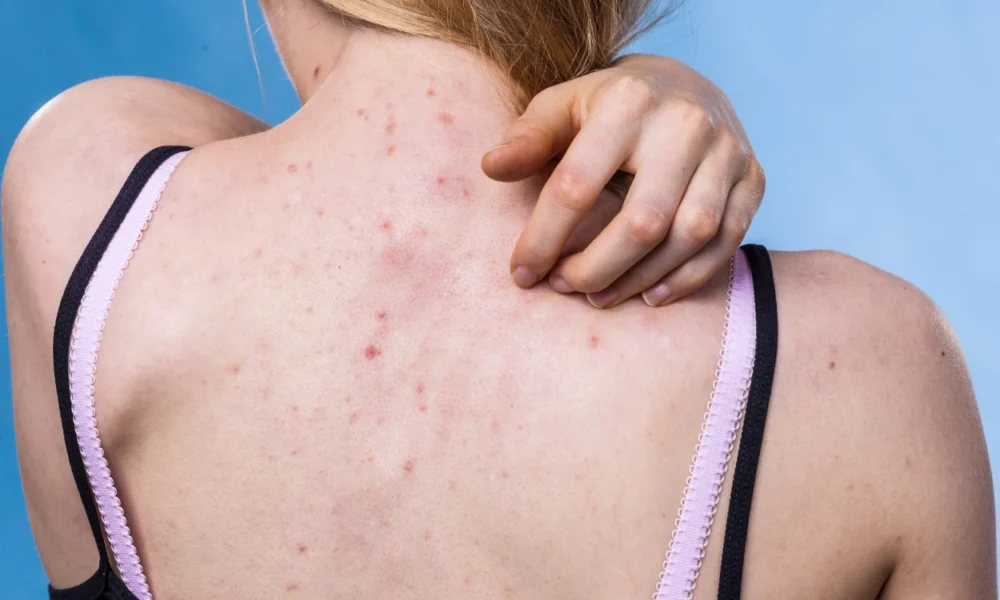 Tips ampuh atasi jerawat di punggung, coba cara ini!