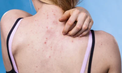 Tips ampuh atasi jerawat di punggung, coba cara ini!