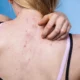 Tips ampuh atasi jerawat di punggung, coba cara ini!