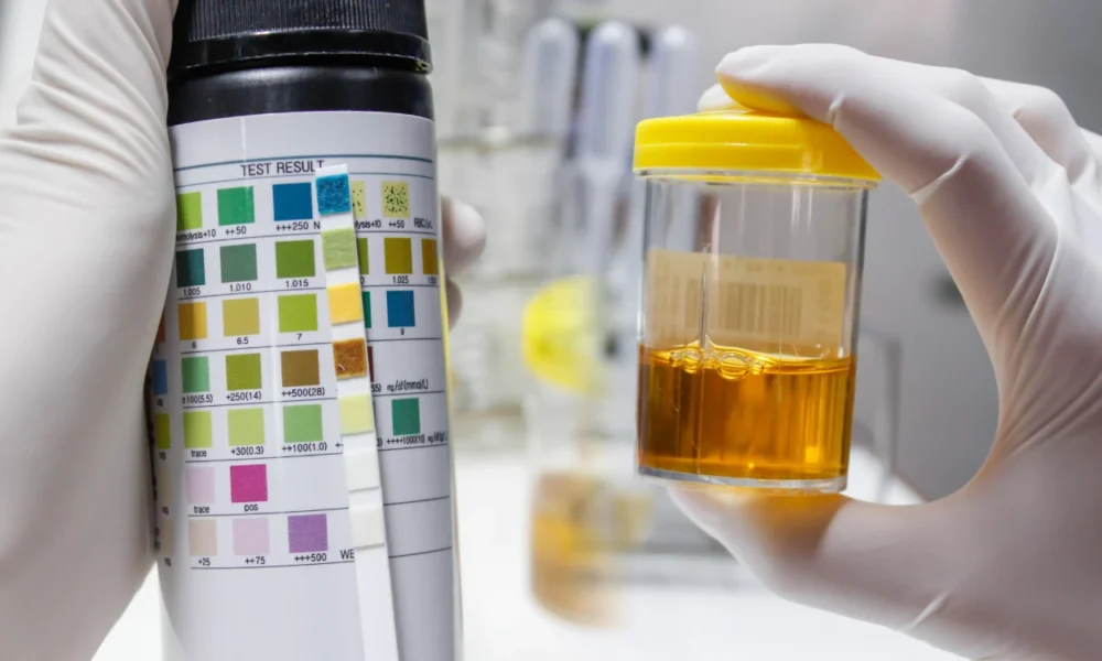 Warna urine bisa jadi petunjuk penyakit serius, kenali perbedaannya