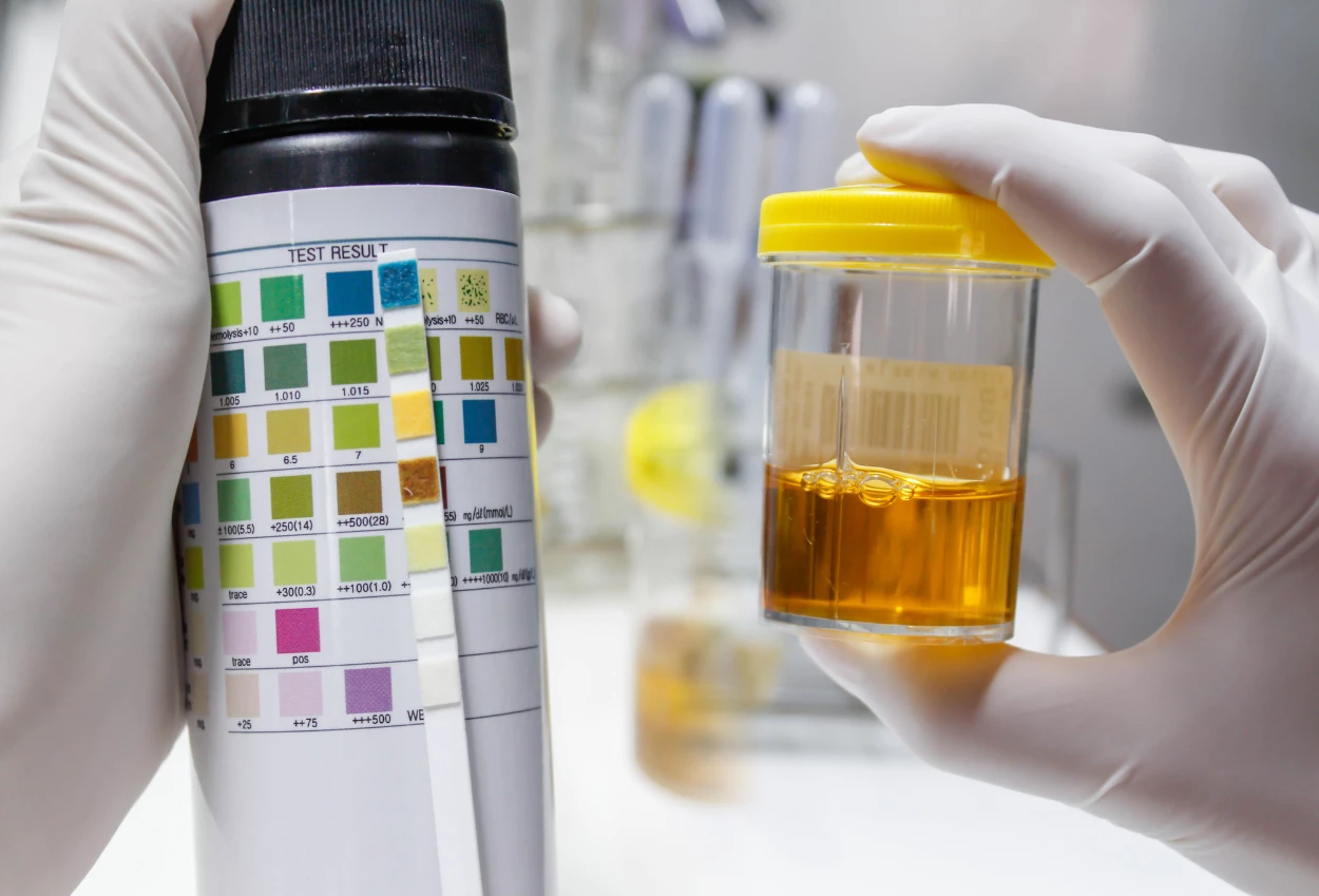 Warna urine bisa jadi petunjuk penyakit serius, kenali perbedaannya