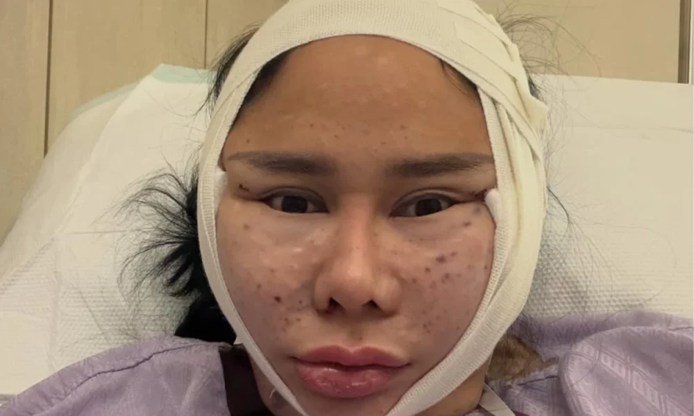 Pamer wajah bengkak usai operasi plastik, denise chariesta muka 1 milyar orang kaya