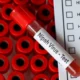 Apa itu nipah virus yang belum ada obatnya!