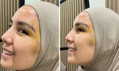 Tya Ariesta Kecelakaan hingga Dapat 8 Jahitan di Wajahnya