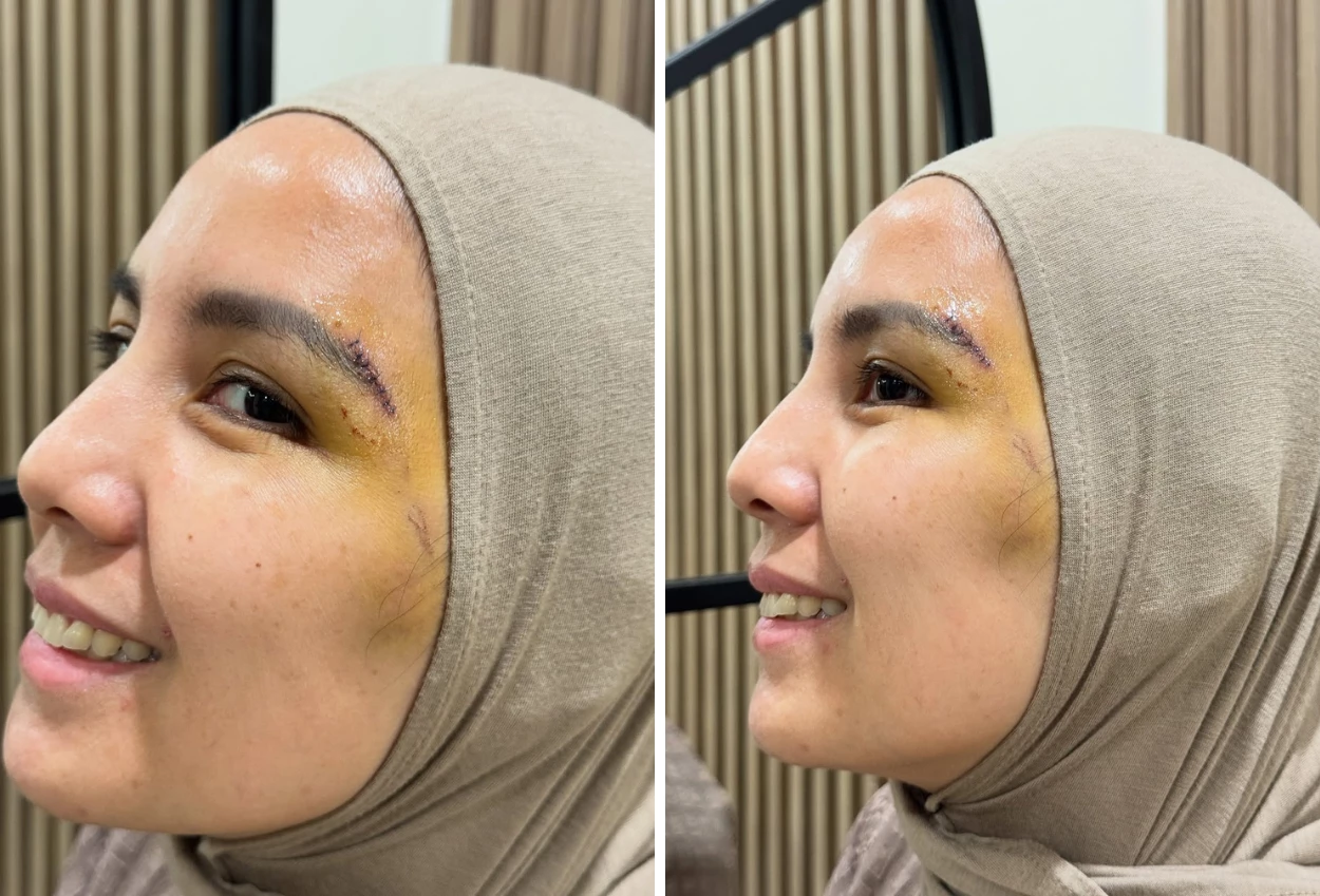 Tya Ariesta Kecelakaan hingga Dapat 8 Jahitan di Wajahnya