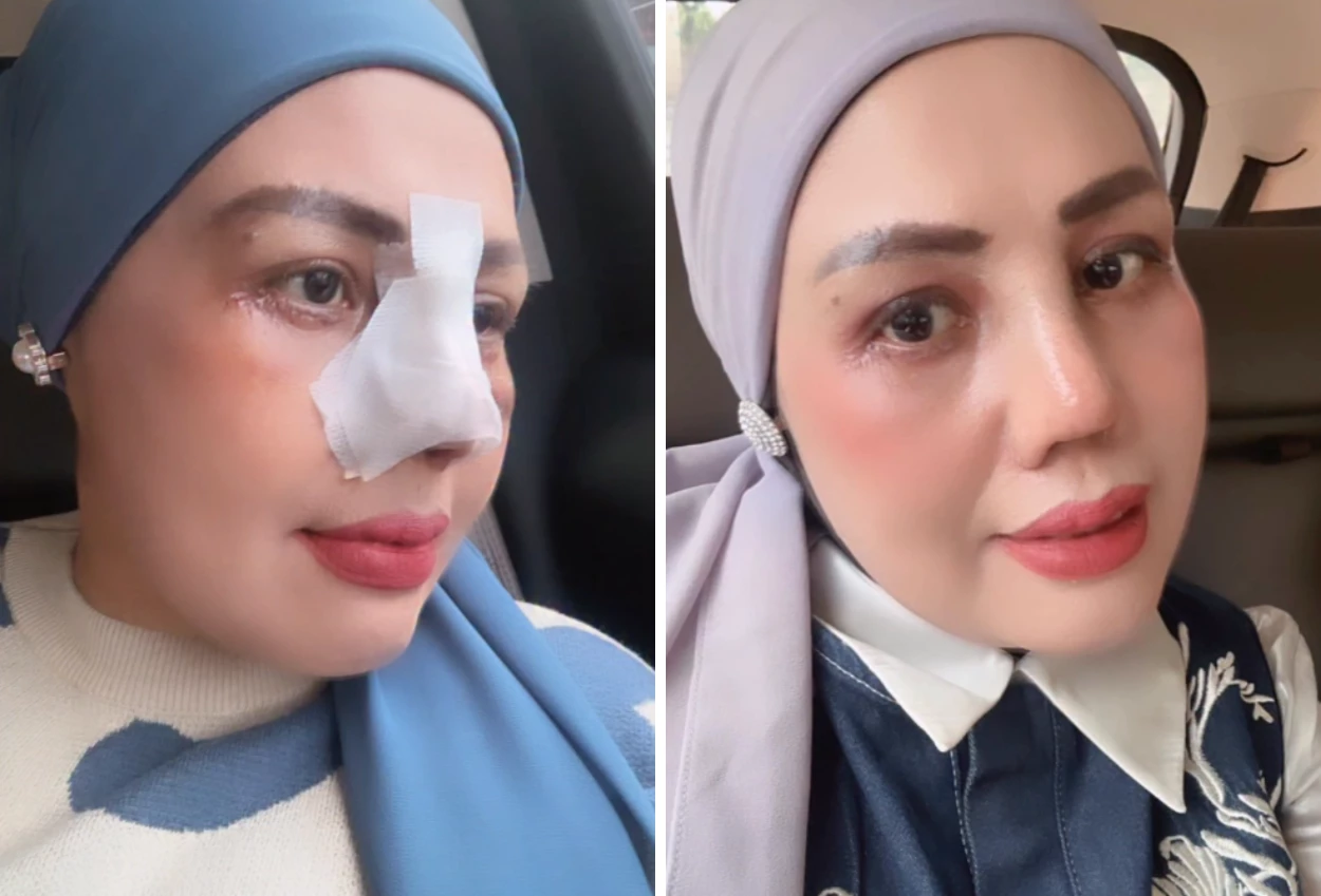 Elly Sugigi Rela Operasi Hidung dan Kelopak Mata, Akui Lelah Dihina Netizen